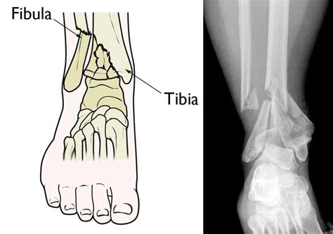 Illustration And X Ray Of A Pilon Fracture Fractures Ankle Joint Ankle