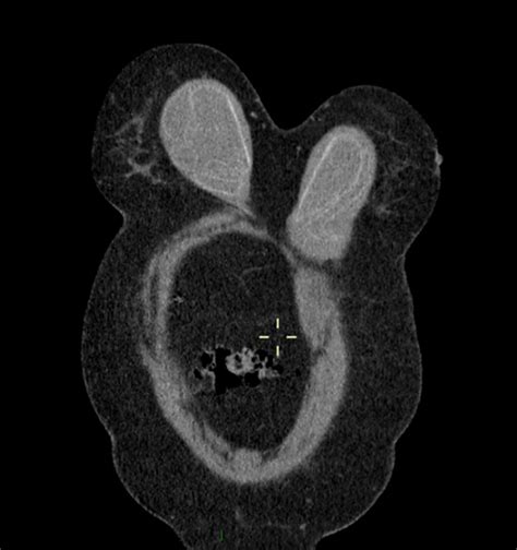 A Preoperative Ct Scan Showing Intracapsular Rupture Of Both Implants