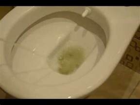Foamy urine without proteinuria - YouTube