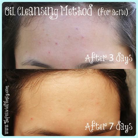 Using The Oil Cleansing Method To Reduce Acne
