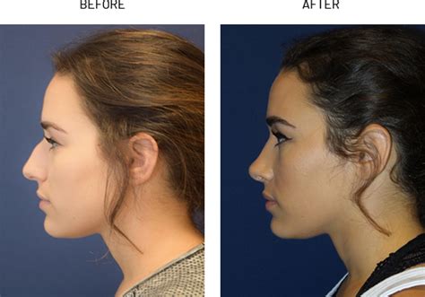 I'm just not sure how high maintenance it'd be. Rhinoplasty Austin | Nose Surgery West Lake Hills