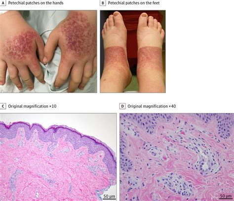 Recurrent Photodistributed Skin Eruptions In A Teenage Girl