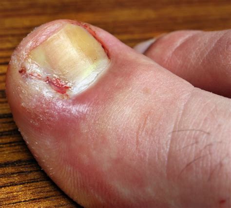 Ingrown Toe Nails 5 Quick Tips To Prevent Ingrown Nails