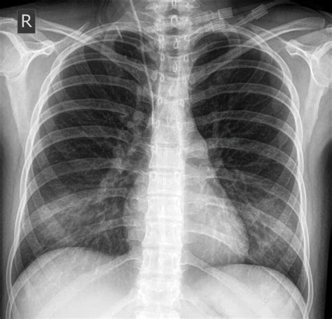Confirming Central Venous Access Position Chest X Ray Medschool