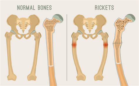 Rickets All You Wanted To Know Apollo Hospitals Blog