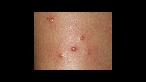 Wikipedia Eosinophilic Pustular Folliculitis Of Infancy Youtu