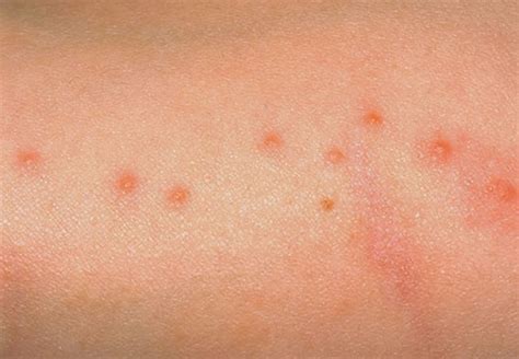 evmestycor: bed bug bites