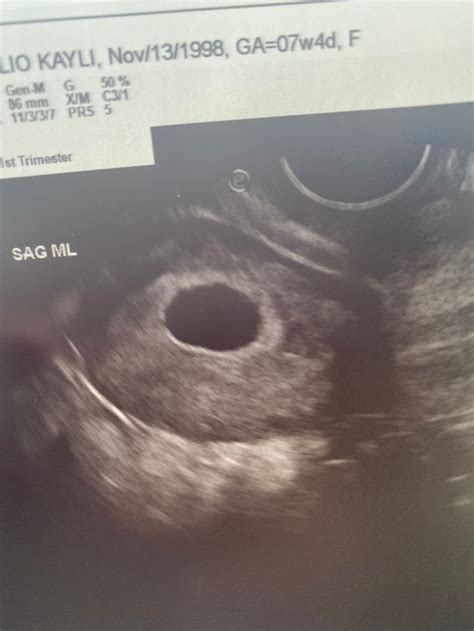 Empty Sac At 7 Weeks Any Hopetimeline Photos
