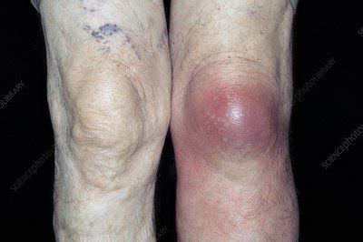 Bursitis Of The Knee Stock Image C Science Photo Library