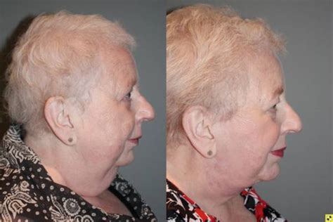 🥇 Atlanta Chin Augmentation Buckhead Chin Implants Plastic Surgery