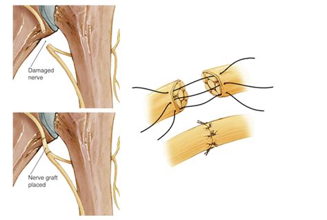 Axillary Nerve Injury