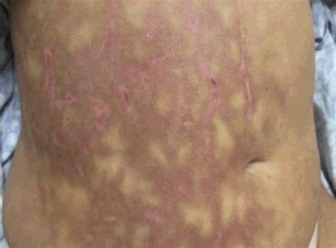 Mottled Skin Livedo Reticularis Causes Treatment And What It Means