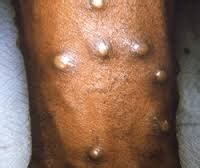 Vaccination against smallpox has been proven to be 85% effective. Monkeypox