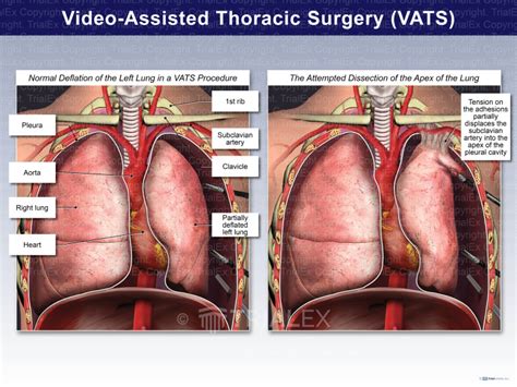 Video Assisted Thoracic Surgery Vats Trial Exhibits Inc