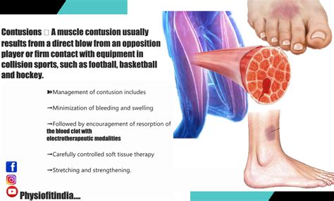 Contusionsmost Common Site Of Muscle Contusions Management Of Contusion