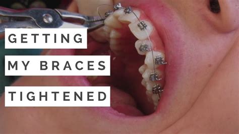 Getting My Braces Tightened For The First Time 1 Month Update With Images Braces Tighten