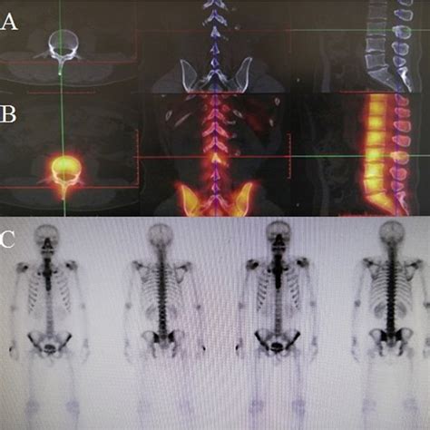 Preoperative Whole Body Bone Scan With Single Photon Emission Computed