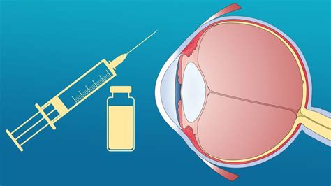 Wet Amd Treatments To Slow Vision Loss Everyday Health