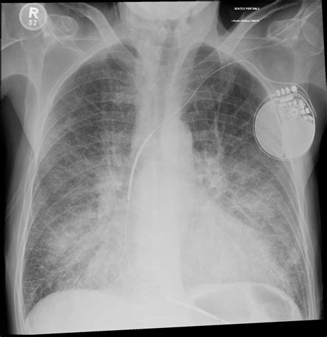 Noncardiogenic Pulmonary Edema Cxr