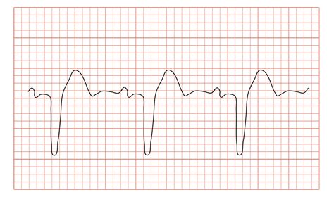 Bundle Branch Block Wikipedia