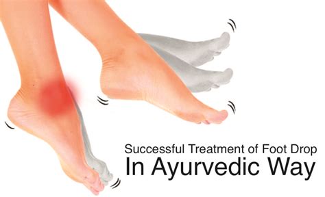Treat Foot Drop With Ayurveda The Science Behind The Tradition
