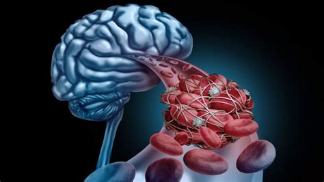 Trombose Venosa Cerebral sintomas e tratamento MD Saúde