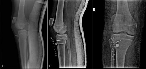 Cureus Neglected Rupture Of The Patellar Tendon After Fixation Of
