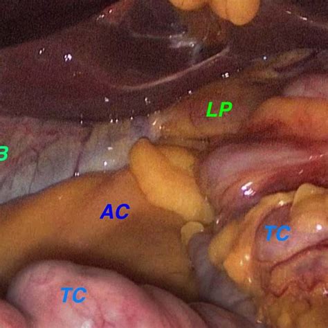 Fixation To The Lateral Wall Of The Ascending Colon With Several