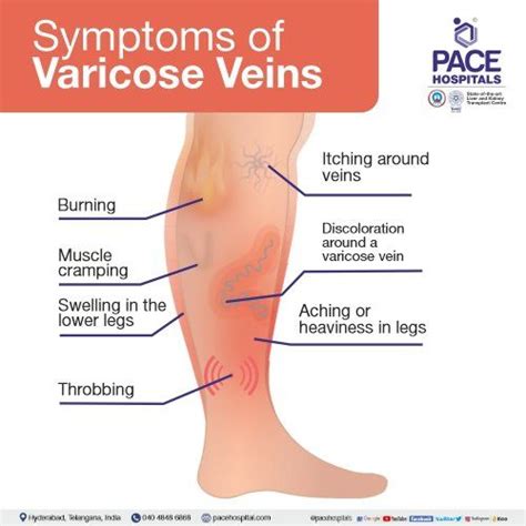 Varicose Veins Symptoms Causes Complications And Treatment