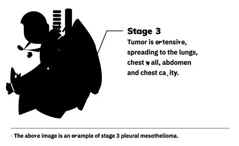 Mesothelioma stages are used by doctors to classify the progression of mesothelioma in a 5.1 why aren't there staging systems for other kinds of mesothelioma? 4 Mesothelioma Stages | Staging Systems & Treatment by Stage