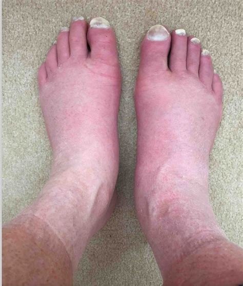 10 Causes For Swollen Feet Why Your Feet Ankles Legs Swell Ph