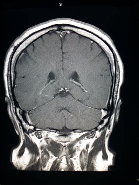 Anterior median fissure, posterior lobe of cerebellum, tonsil of cerebellum, pyramids. #Normal #coronal #MRI of the #brain in a #patient with # ...