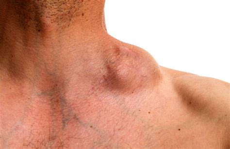 Swollen Lymph Nodes Groin Hiv