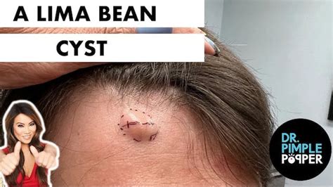 Double Opening Back Cyst Cystactular Cysts Dr Pimple Popper