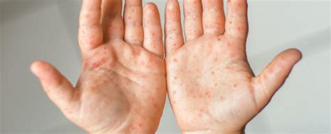 Does My Child Have Hand Foot And Mouth Disease Osf Healthcare
