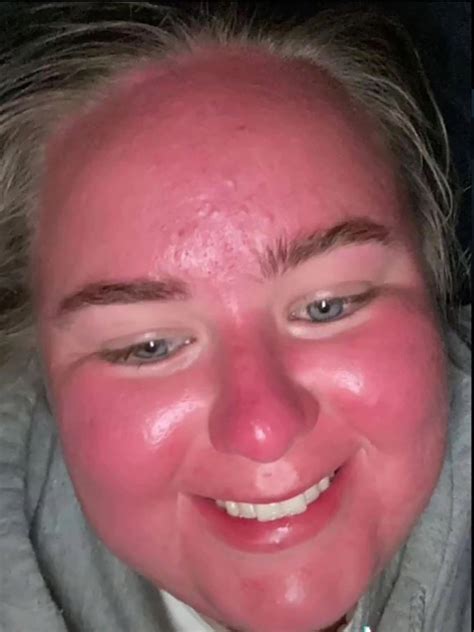 Womans Face Doubles In Size After Spending An Hour In The Sun