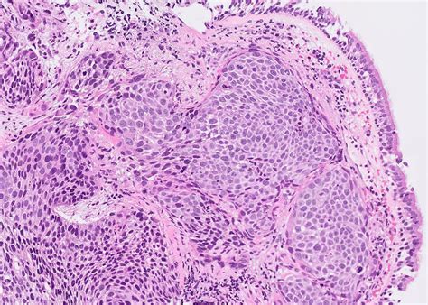 Squamous Cell Carcinoma Lung Histology