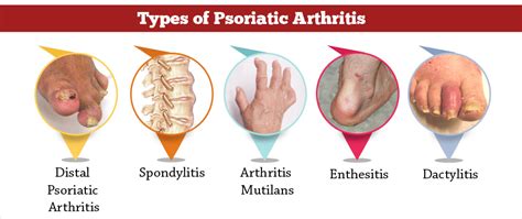 Psoriatic Arthritis Types Causes Risk Factors Diagnosis Treatment