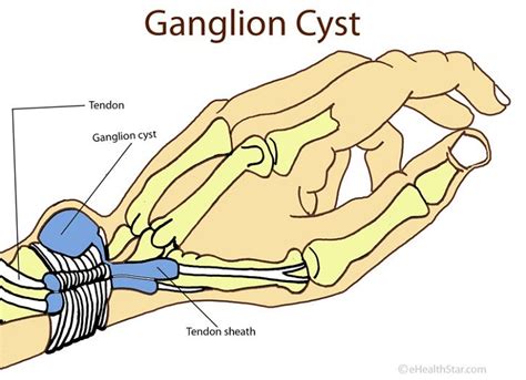 Causes Symptoms And Treatment Of Ganglion Cysts Natstringersmusings