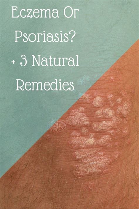 Psoriasis Home Remedies Brea Getting Fit Psoriasis Cure Remedies