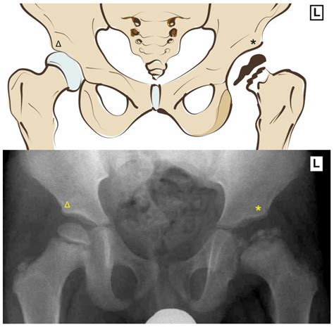 Pediatric Reports Free Full Text Rate Of Total Hip Replacement