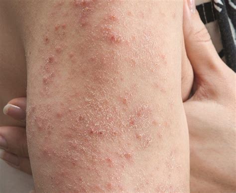 Celiac Thats Skin Deep The Mysterious Rash Sparked By Gluten Celiac