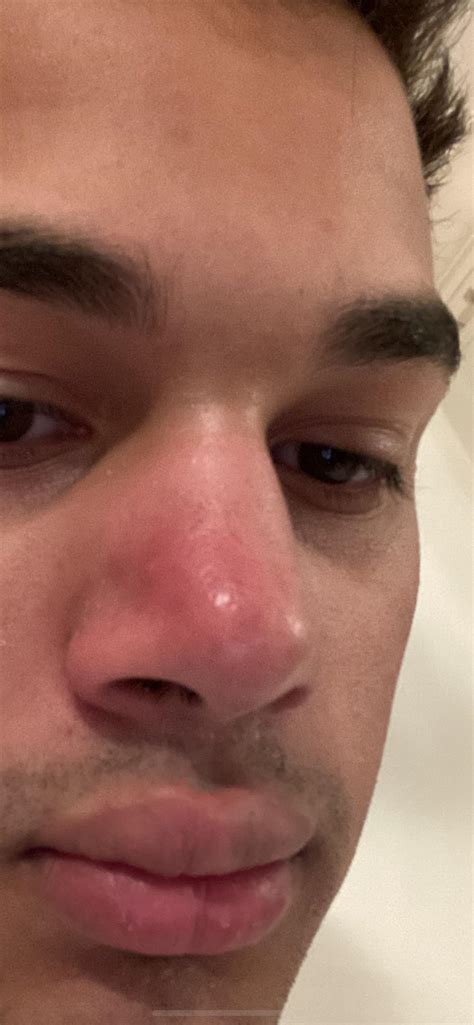 My Nose Keeps Getting These Inflamed Bright Red Spots Anyone Know What