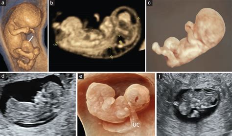 Sonographic Detection Of Fetal Abnormalities Before 11 Weeks Of
