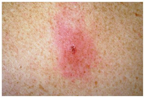 Erythema Migrans Patient A At Day 3 Biopsy Day Download Scientific