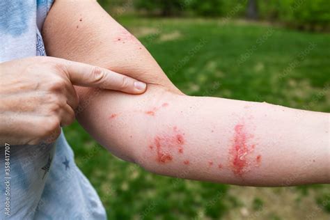 Severe Poison Ivy Poison Oak Rash And Boils And Blisters On Womans Arm