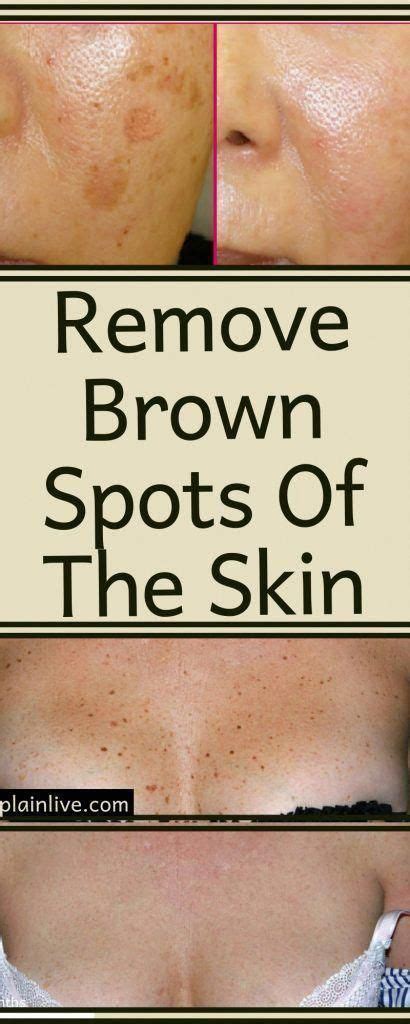 How To Get Rid Of Black Spots On Face Brownspotsbetweenteeth