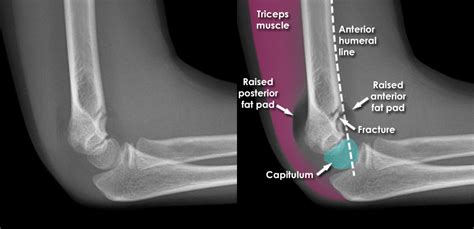 Trauma X Ray Upper Limb Gallery 1 Elbow Supracondylar Fracture