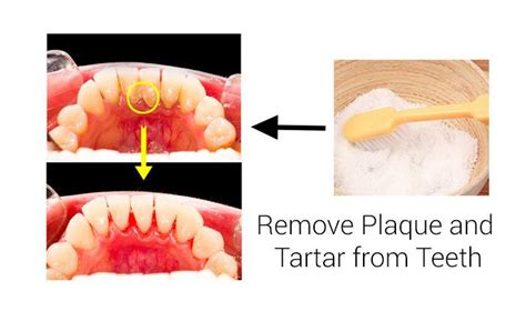 One of the oldest ingredients used to help remove plaque from your teeth is baking powder. How to Naturally Remove Plaque and Tartar from Teeth | Top ...