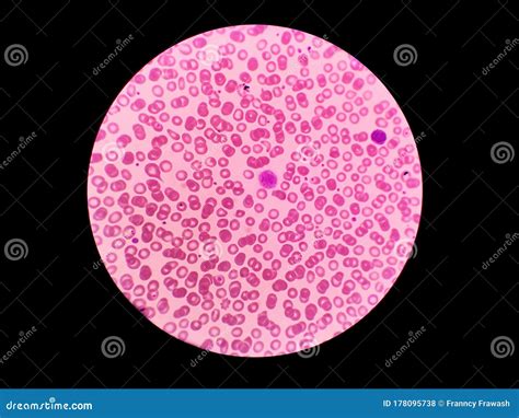 Platelets Macrothrombocyte Blood Test Red Blood Cells Stock Photo